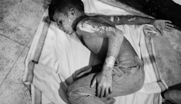 Kite electrocution incident injures boy in Sangareddy